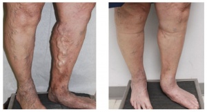 vein disease photo dr lee doohi plano tx