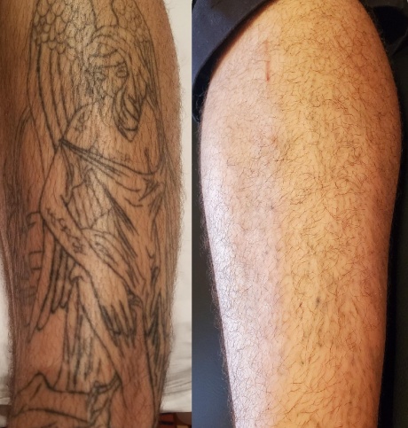 arm tattoo removal plano tx